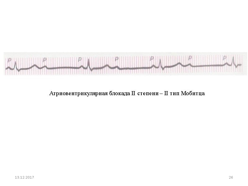 13.12.2017 26 Атриовентрикулярная блокада II степени – II тип Мобитца